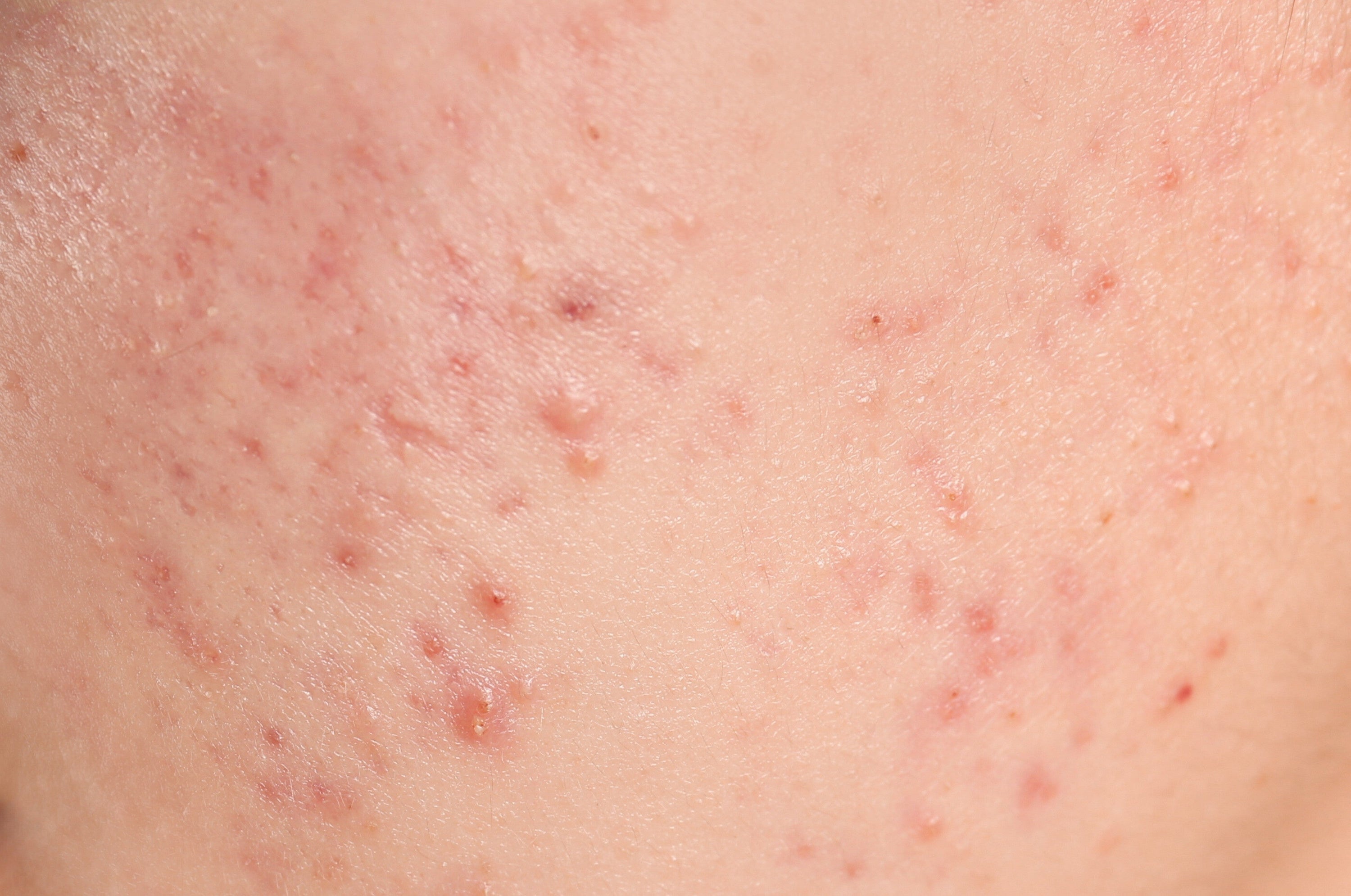 Protocollo Skincare Pelle Impura