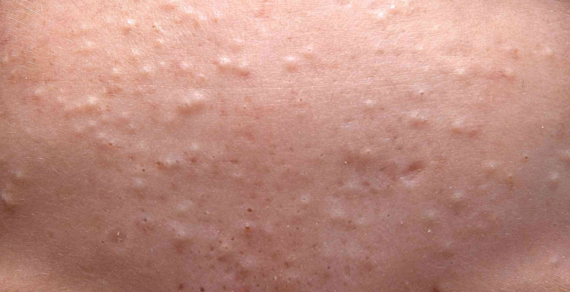 Acne Comedonica