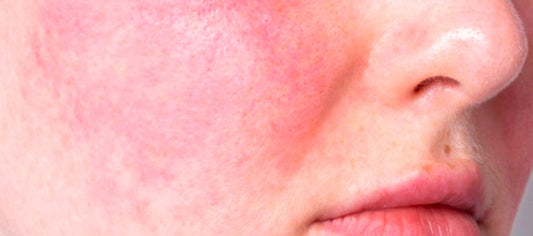 Rosacea