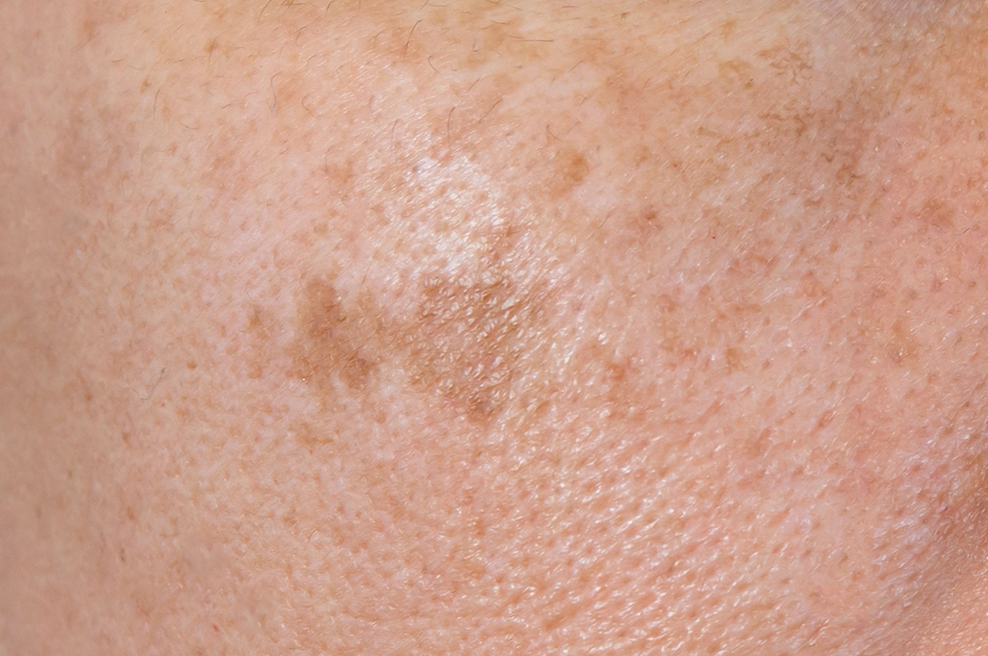 Protocollo Skincare per Macchie Brune